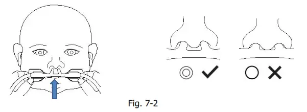 BMC NC11L Nasal Cannula - nostril 4