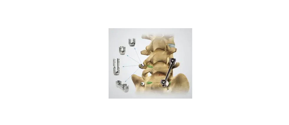 Orthofix Spinal Fixation System Instructions Orthofix Spinal Fixation System Instructions