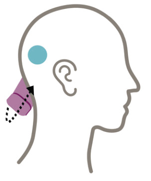 Cochlear Osia 2 Hearing System- Bandaging