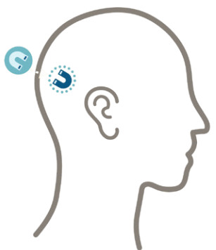 Cochlear Osia 2 Hearing System- Preparation 2