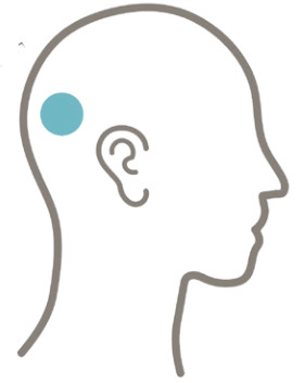 Cochlear Osia 2 Hearing System- Preparation 3