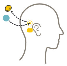 Cochlear Osia 2 Hearing System- Preparation