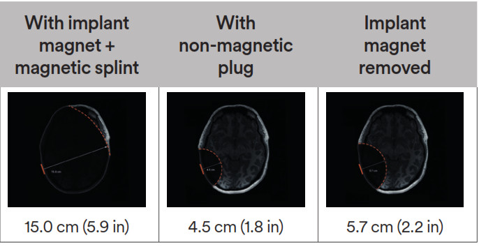Cochlear Osia 2 Hearing System- T scans