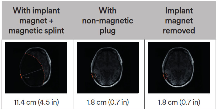 Cochlear Osia 2 Hearing System- Table 2