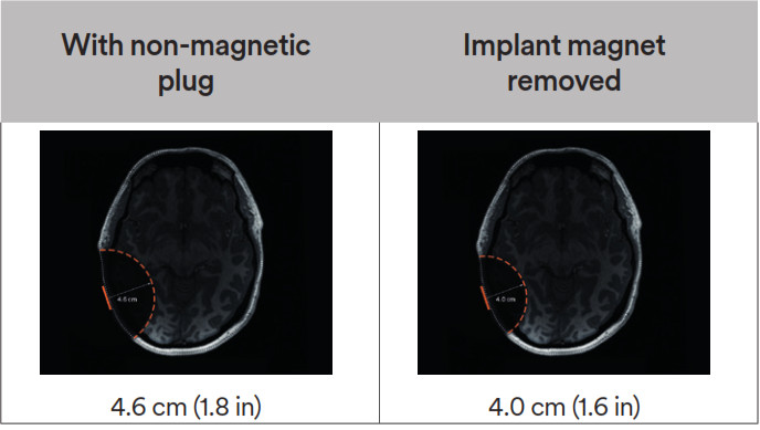 Cochlear Osia 2 Hearing System- Table 3-1