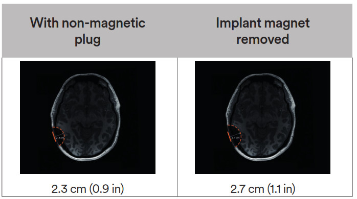Cochlear Osia 2 Hearing System- Table 4