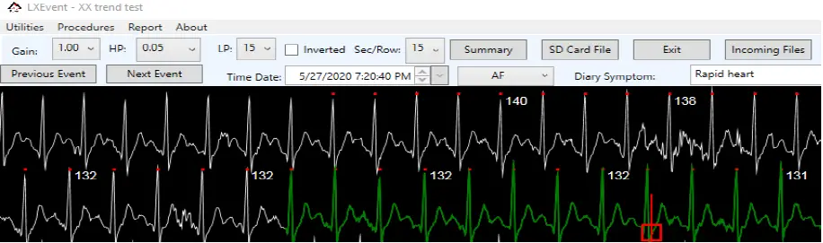 NorthEast-Monitoring-LX-Event-DR400-Patch-Style-Holter-Recorder-FIG-7