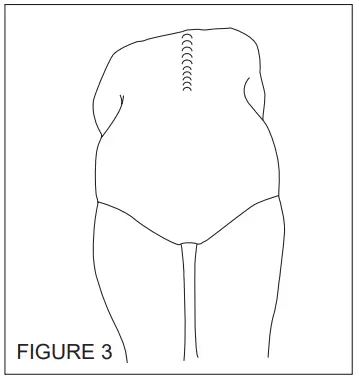 BASELINE 12-1099 Scoliosis Meter-3