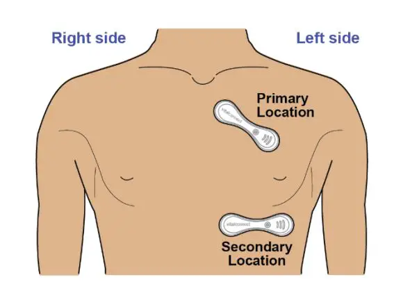VitalConnect-VitalPatch-Adhesive-Overlay-Cardiac-Monitoring-Device-fig1