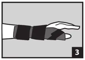McKESSON 155-79-87113 Thumb Spica Splints - FIG 1