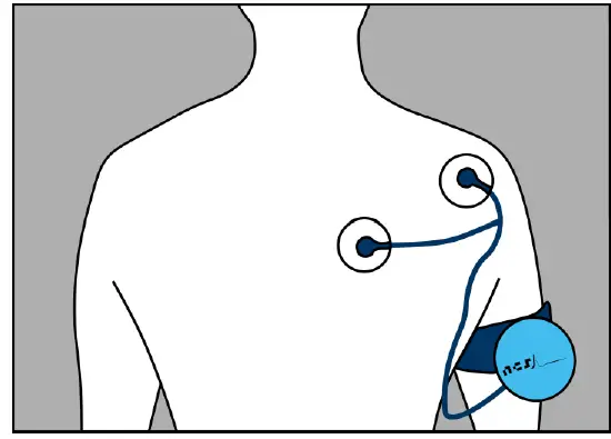 NCS Shoulder Pacemaker Device FIG 5