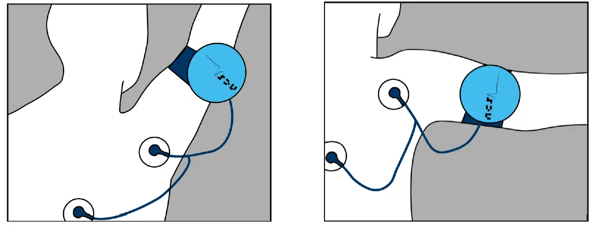 NCS Shoulder Pacemaker Device FIG 6