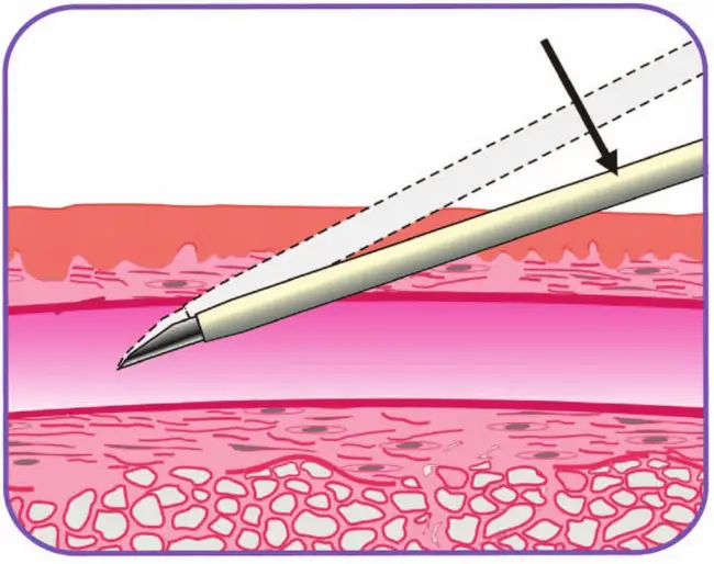 BD Nexiva Closed IV Catheter System - Lower and Advance