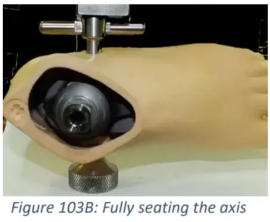 Trulife SKF100 Kinetic Foot Ankle and Pylon System for K2 Level - Fig 16