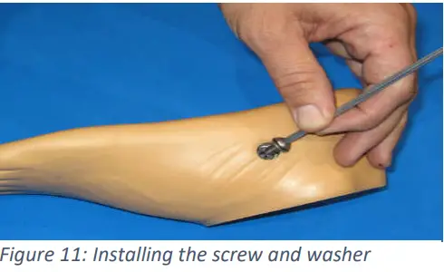 Trulife SKF100 Kinetic Foot Ankle and Pylon System for K2 Level - Fig 17