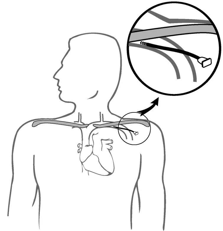 ST JUDE MEDICAL 1944 IsoFlex J Shape Pacing Lead - Figure