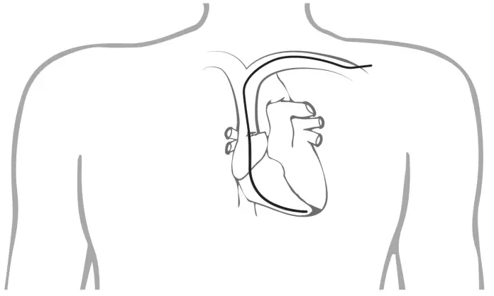 ST JUDE MEDICAL 1944 IsoFlex J Shape Pacing Lead - Introducing