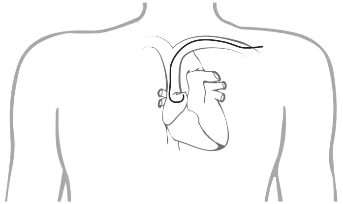 ST JUDE MEDICAL 1944 IsoFlex J Shape Pacing Lead - Placement