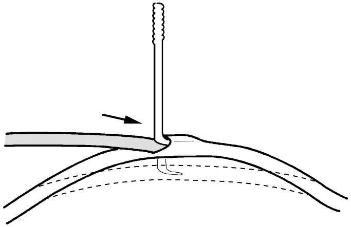 ST JUDE MEDICAL 1944 IsoFlex J Shape Pacing Lead - technique