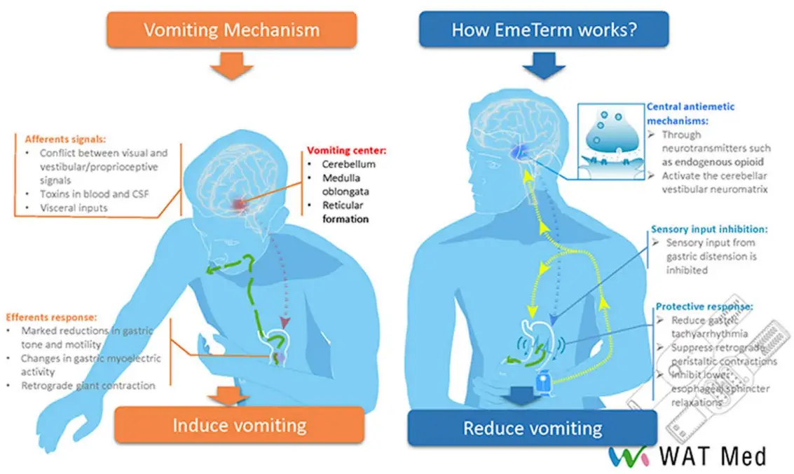 EmeTerm Motion Sickness Anti Emetic Band - FIG 1