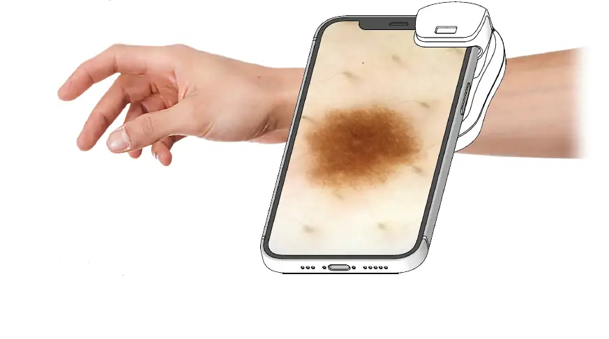 MoleScope P002-004-QSGB Phone Camera FIG 4