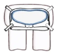 Leckey Pelvic Harness Cradle Measuring FIG 2