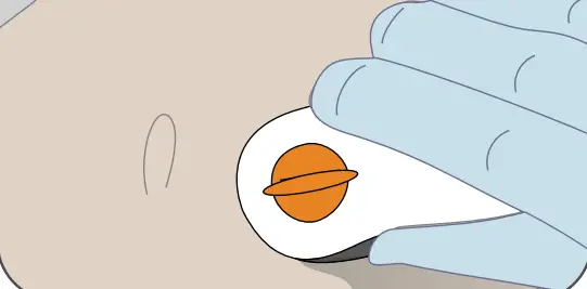 Dexcom G6 Pro Glucose Monitoring System - Fig 3