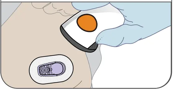 Dexcom G6 Pro Glucose Monitoring System - Fig 6