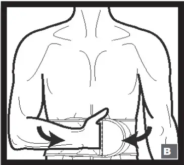 DONJOY Isoform LSO+ Back Brace Patient - HELPFUL TIP BRACE MIGRATION