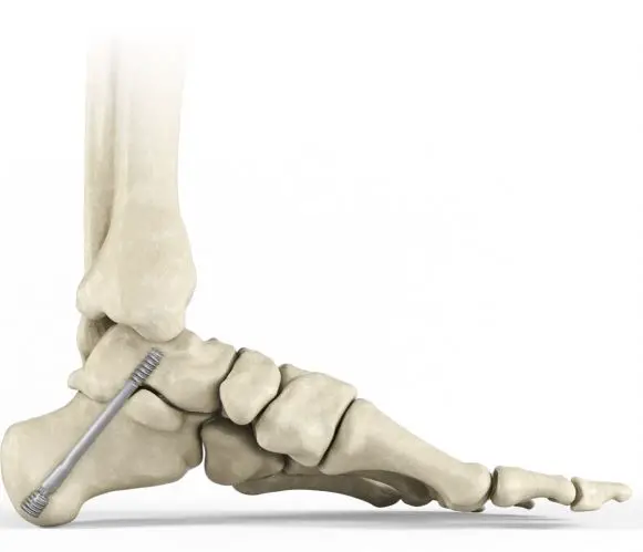 enovis-DynaNail-Helix-Fixation-System-PRODUCT