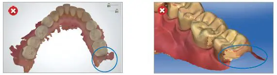 ResMed Narval CC Mandibular Advancement Device fig 10