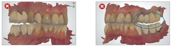 ResMed Narval CC Mandibular Advancement Device fig 11