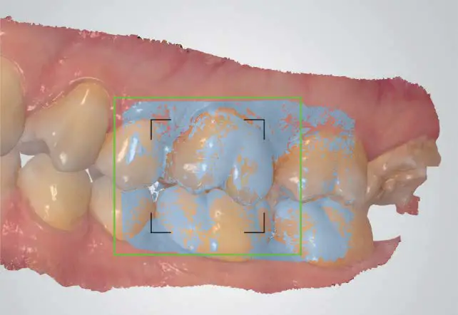 ResMed Narval CC Mandibular Advancement Device fig 4