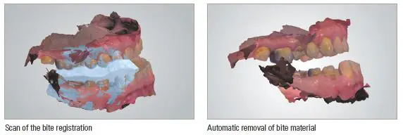 ResMed Narval CC Mandibular Advancement Device fig 5