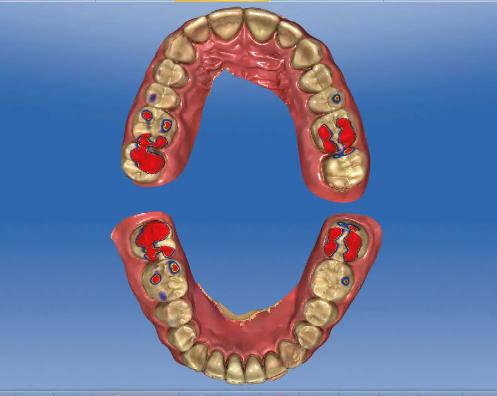 ResMed Narval CC Mandibular Advancement Device fig 6