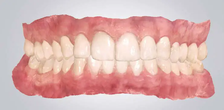 ResMed Narval CC Mandibular Advancement Device fig 7