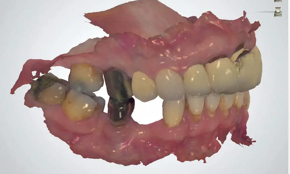 ResMed Narval CC Mandibular Advancement Device fig 8
