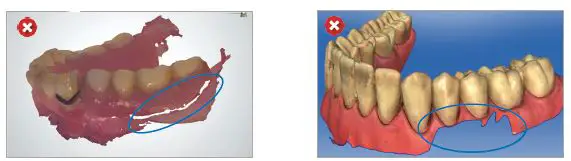 ResMed Narval CC Mandibular Advancement Device fig 9