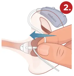 otofonix Apex Hearing Aid for Senior and Adults-Ear1