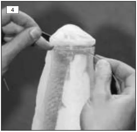 Fabricating the prosthetic socket