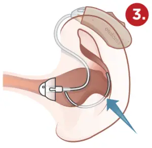 otofonix Encore Hearing Aid Hearing Amplifier for Ear-Ear3