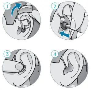FIG 2 Insertion and Removal