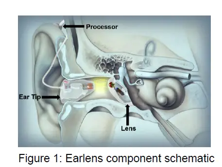 earlens IFU00037 Contact Hearing Solution fig 1