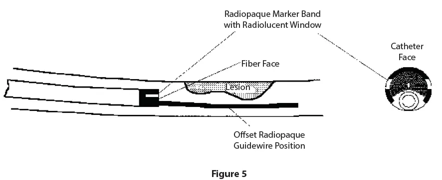 Spectranetics-ELCA-OTW-and-RX-Catheter-Models-fig5