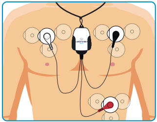 MCOT BIOTEL LEAD WIRE ADAPTER - 11