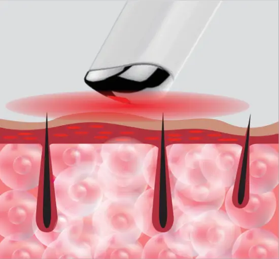 EvenSkyn Venus Premium Eyelid Anti Aging Device - fig5