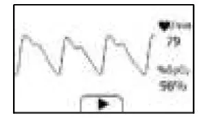 viatom-PD-30092-Checkme-Lite -Health-Monitor-fig14