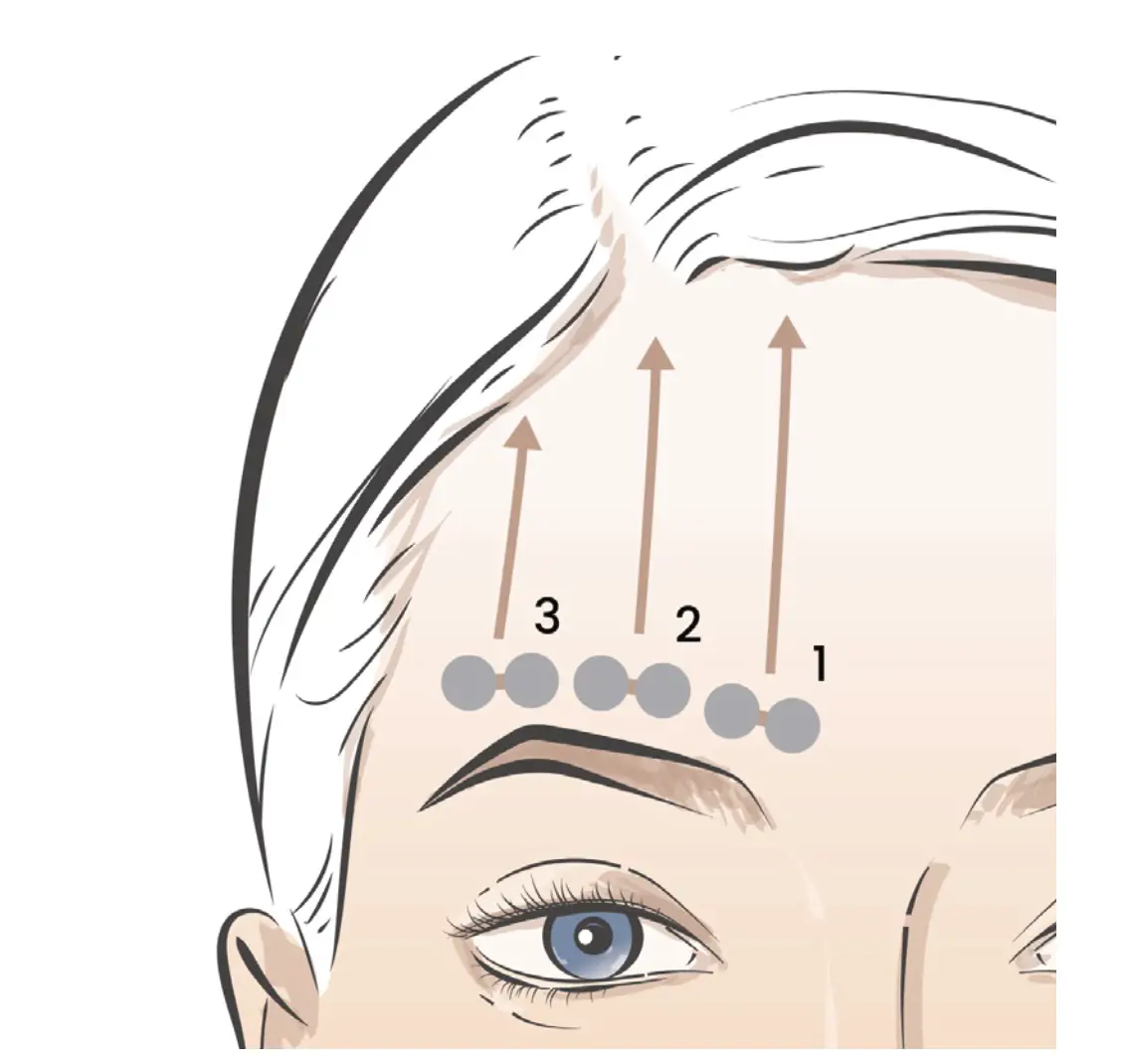 TENS-K-UNIWAND Target Fine Lines and Wrinkles for a Non-Invasive Facelift - Forehead
