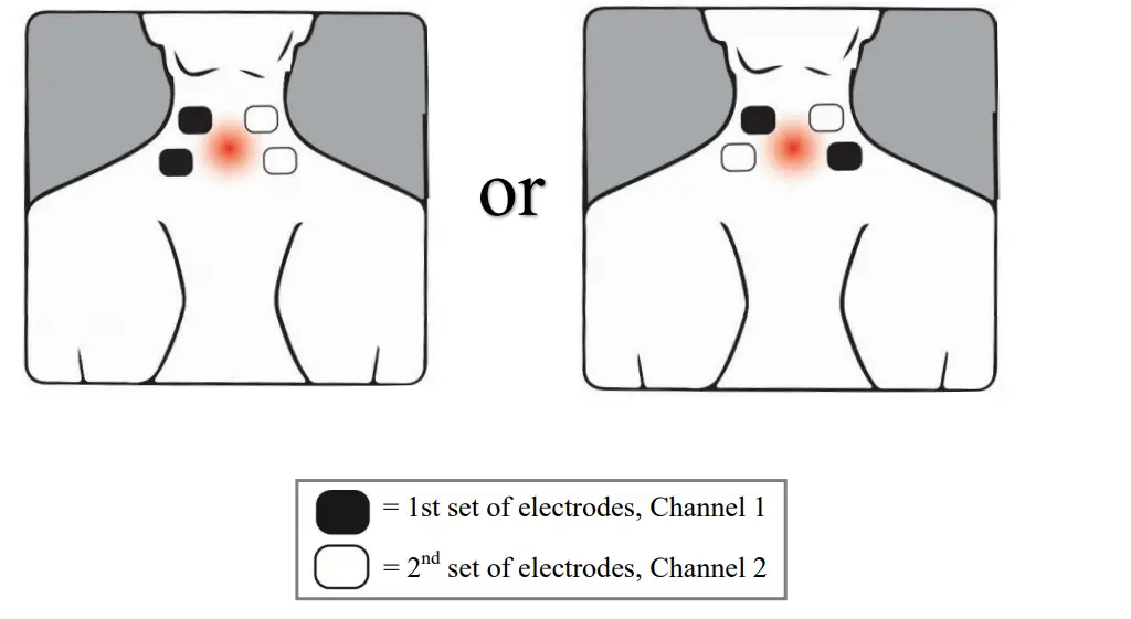 YU-UNIVERSE-Transcutaneous-Electrical-Nerve-Stimulator-FIG-2