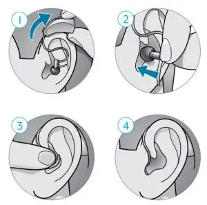 FIG 1 Insertion and Removal